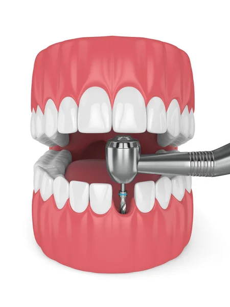 Render Állkapocs Fúróval Fogászati Implantátum Implantáció Folyamat Fogalma — Stock Fotó