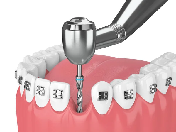 교정기와 드릴의 렌더링 중괄호 — 스톡 사진