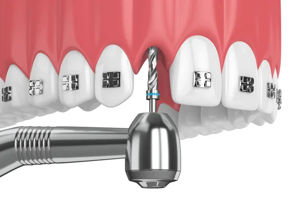 Rendu Des Dents Avec Des Appareils Orthodontiques Perceuse Dentaire Orthèse — Photo