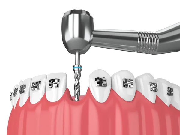 矯正中かっこと歯科用ドリル歯の のレンダリング 矯正ブレース コンセプト — ストック写真
