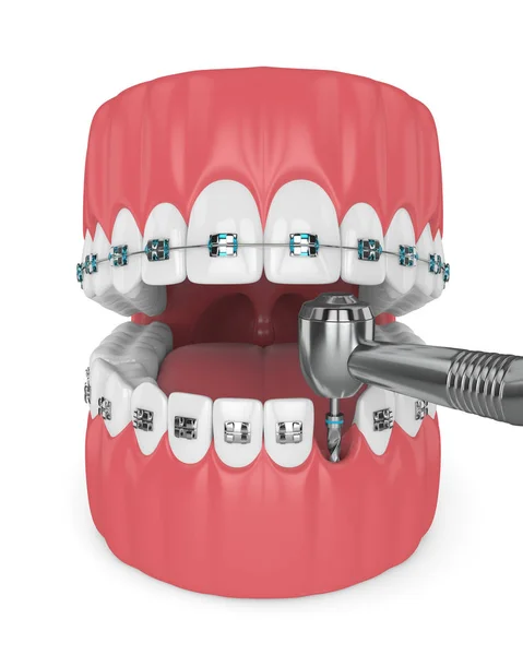 Візуалізація Зубів Ортодонтичними Брекетами Стоматологічним Дрилем Концепція Ортодонтичних Брекетів — стокове фото