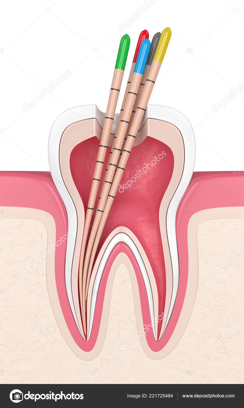 Gutta Percha In Tooth