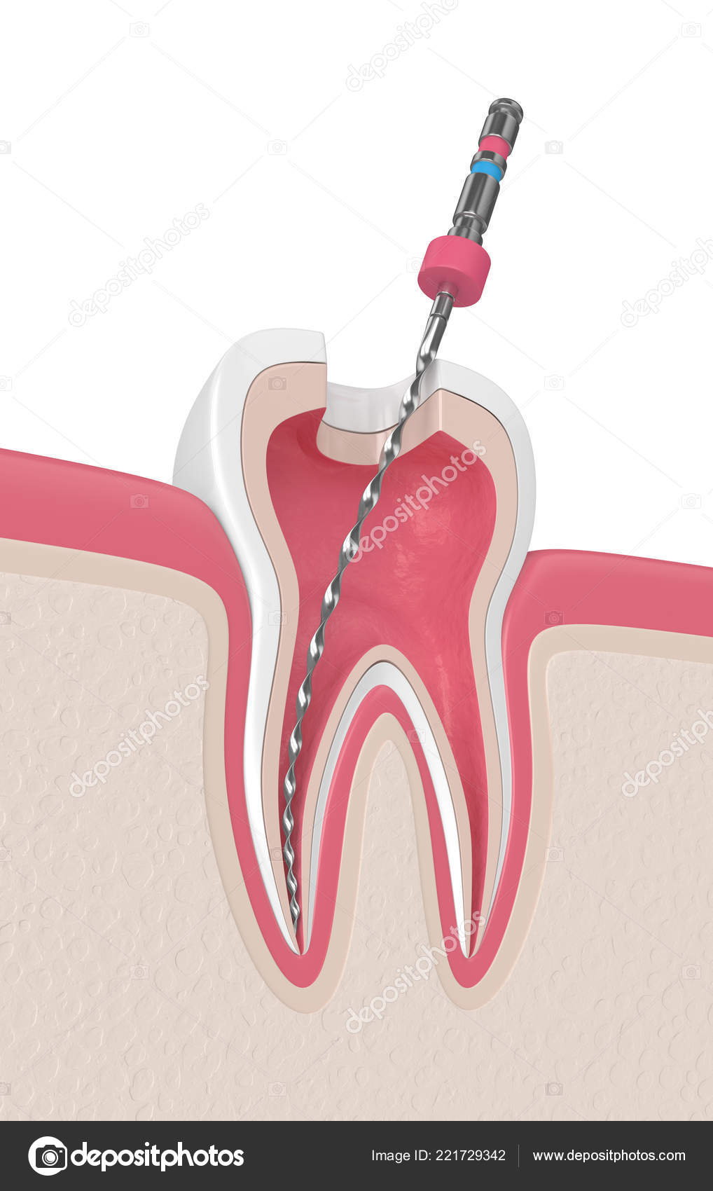 Render Tooth Endodontic File Gums Root Canal Treatment Concept Stock