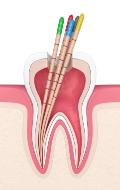 3d render of tooth in gums with gutta percha with white background clipart