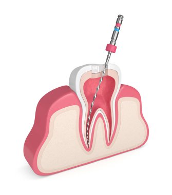 3d render of tooth with endodontic file  in gums over white background. Root canal treatment concept. clipart