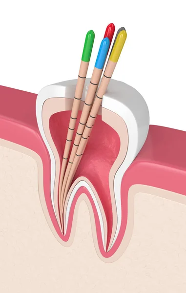 Rendering Denti Gengive Con Gutta Percha Con Sfondo Bianco — Foto Stock