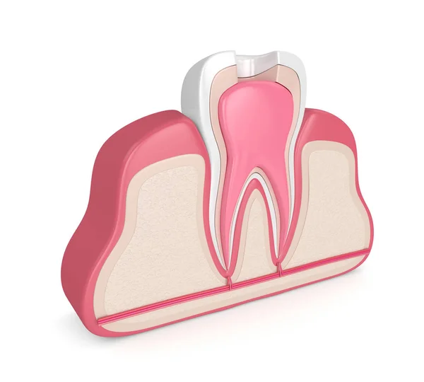 Render Zęba Dziąsła Procedury Leczenia Kanałowego — Zdjęcie stockowe