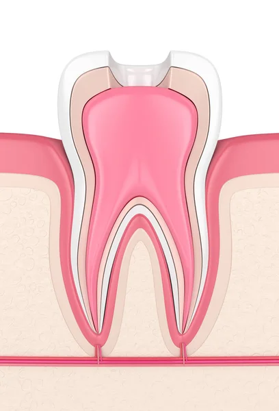 3d render of tooth in gums with root canal treatment procedure