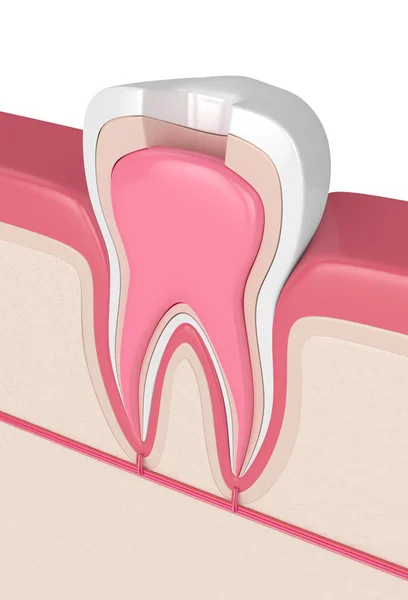 Renderização Dente Gengivas Com Procedimento Tratamento Canal Radicular — Fotografia de Stock