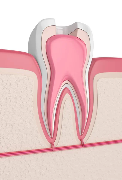 3d render of tooth in gums with root canal treatment procedure