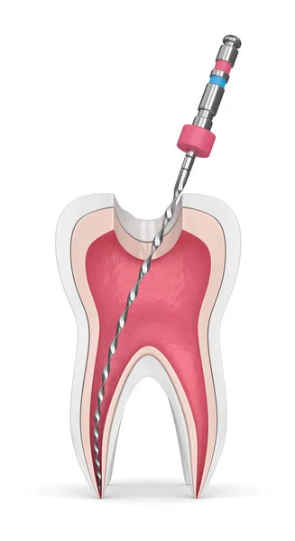 Rendering Dente Con File Endodontico Sfondo Bianco Concetto Trattamento Del — Foto Stock