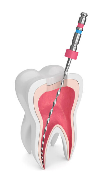 3d render of tooth with endodontic file over white background. Root canal treatment concept.