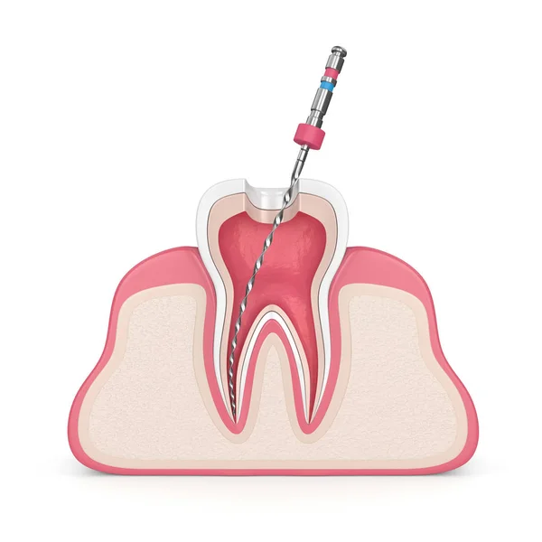 Rendering Dente Con File Endodontico Gengive Sfondo Bianco Concetto Trattamento — Foto Stock