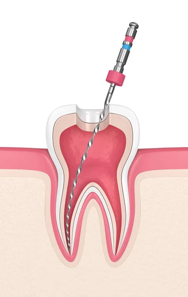 Darstellung Des Zahnes Mit Endodontischer Feile Zahnfleisch Wurzelkanalbehandlungskonzept — Stockfoto