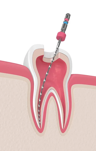 diş diş etleri Endodontik dosyası ile 3D render. Kök kanal tedavisi kavramı.
