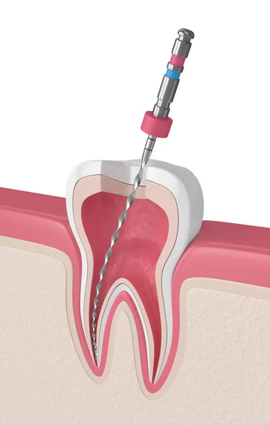 Darstellung Des Zahnes Mit Endodontischer Feile Zahnfleisch Wurzelkanalbehandlungskonzept — Stockfoto