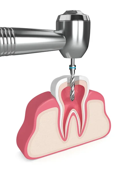 Render Tanden Tandköttet Med Dental Borr — Stockfoto