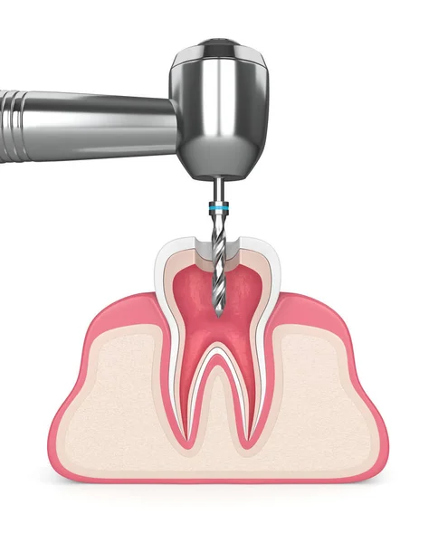 Render Tanden Tandköttet Med Dental Borr — Stockfoto