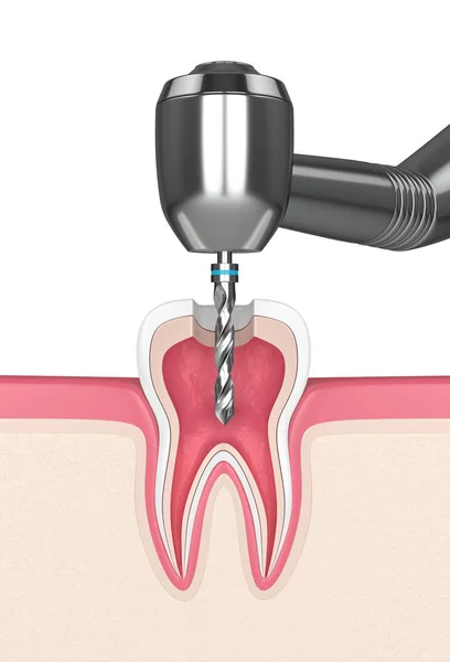Render Tooth Gums Dental Drill — Stock Photo, Image