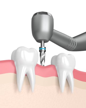 3D render diş diş matkap ile. Dental implant kavramı
