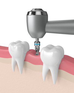 3D render diş diş matkap ile. Dental implant kavramı