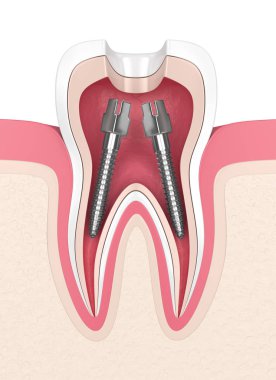 diş etleri diş kök kanal mesajlar içinde 3D render