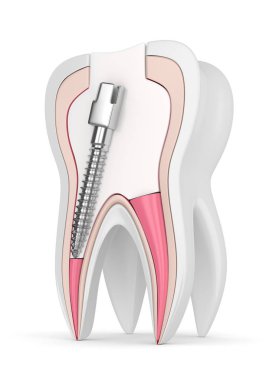 3D render diş gutta percha, post ve üzerinde beyaz dolgu ile. Endodontik tedavi kavramı