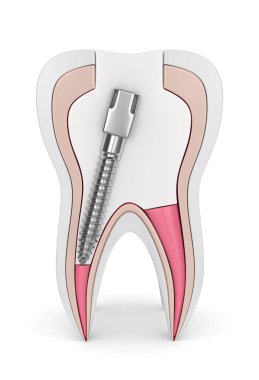 3D render diş gutta percha, post ve üzerinde beyaz dolgu ile. Endodontik tedavi kavramı