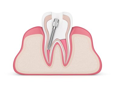 3D render gutta percha, yazı ve diş etleri içinde girmede diş. Endodontik tedavi kavramı