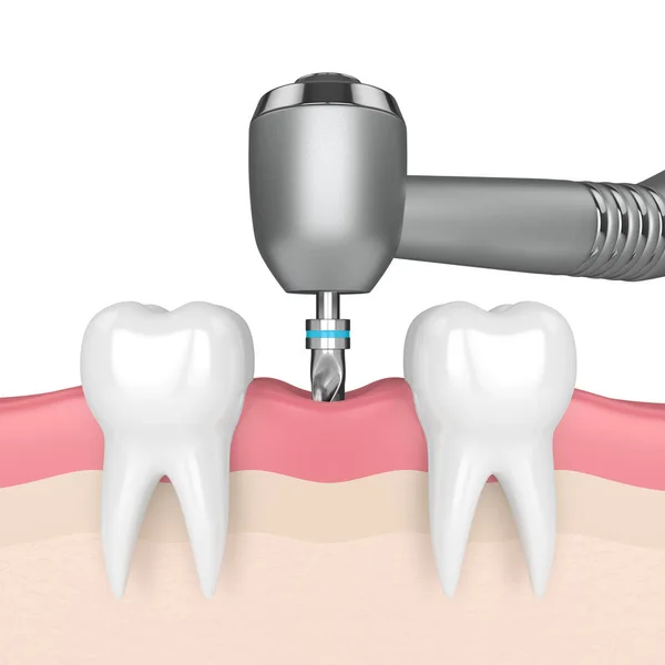 3d render of teeth with dental drill. Dental implant concept