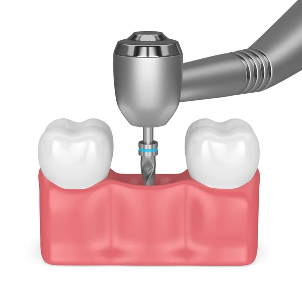 Renderização Dentes Com Broca Dentária Conceito Implante Dentário — Fotografia de Stock