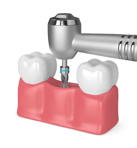 Renderização Dentes Com Broca Dentária Conceito Implante Dentário — Fotografia de Stock