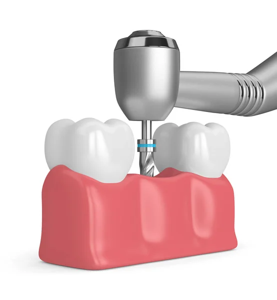 Rendering Denti Con Trapano Dentale Concetto Impianto Dentale — Foto Stock
