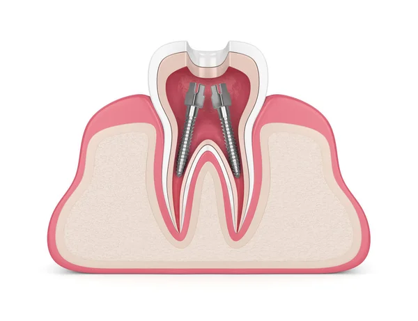Renderização Dente Gengivas Com Postes Canal Raiz Dental — Fotografia de Stock