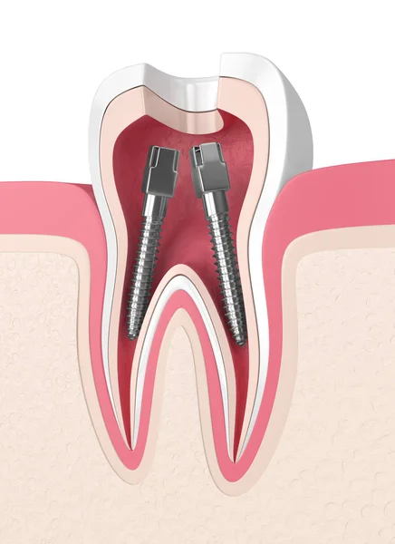 渲染牙齿在牙龈与牙根管柱 — 图库照片