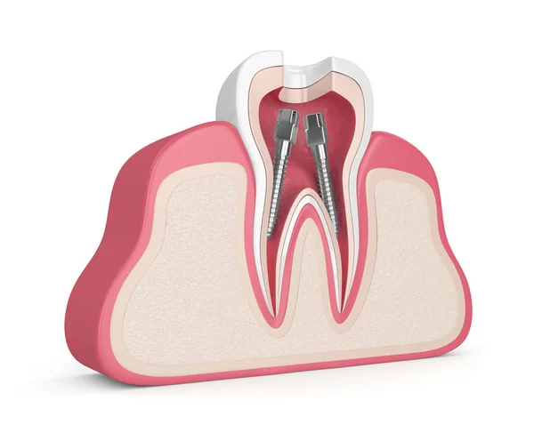 Renderizado Dientes Encías Con Postes Conductos Radiculares Dentales — Foto de Stock