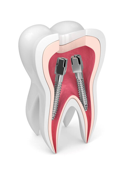 3d render of tooth with dental root canal posts over white