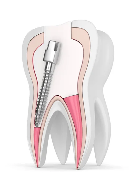 Renderização Dente Com Guta Percha Pós Enchimento Sobre Branco Conceito — Fotografia de Stock