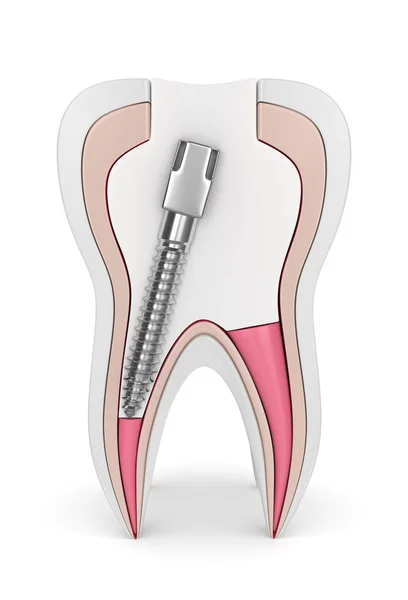 Render Diş Gutta Percha Post Üzerinde Beyaz Dolgu Ile Endodontik — Stok fotoğraf
