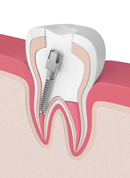 Render Gutta Percha Yazı Diş Etleri Içinde Girmede Diş Endodontik — Stok fotoğraf