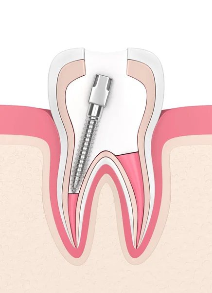 ガッタバーチャ ポスト歯茎の充填と歯の のレンダリング 歯内治療コンセプト — ストック写真
