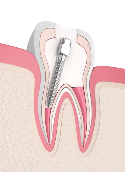 Render Gutta Percha Yazı Diş Etleri Içinde Girmede Diş Endodontik — Stok fotoğraf