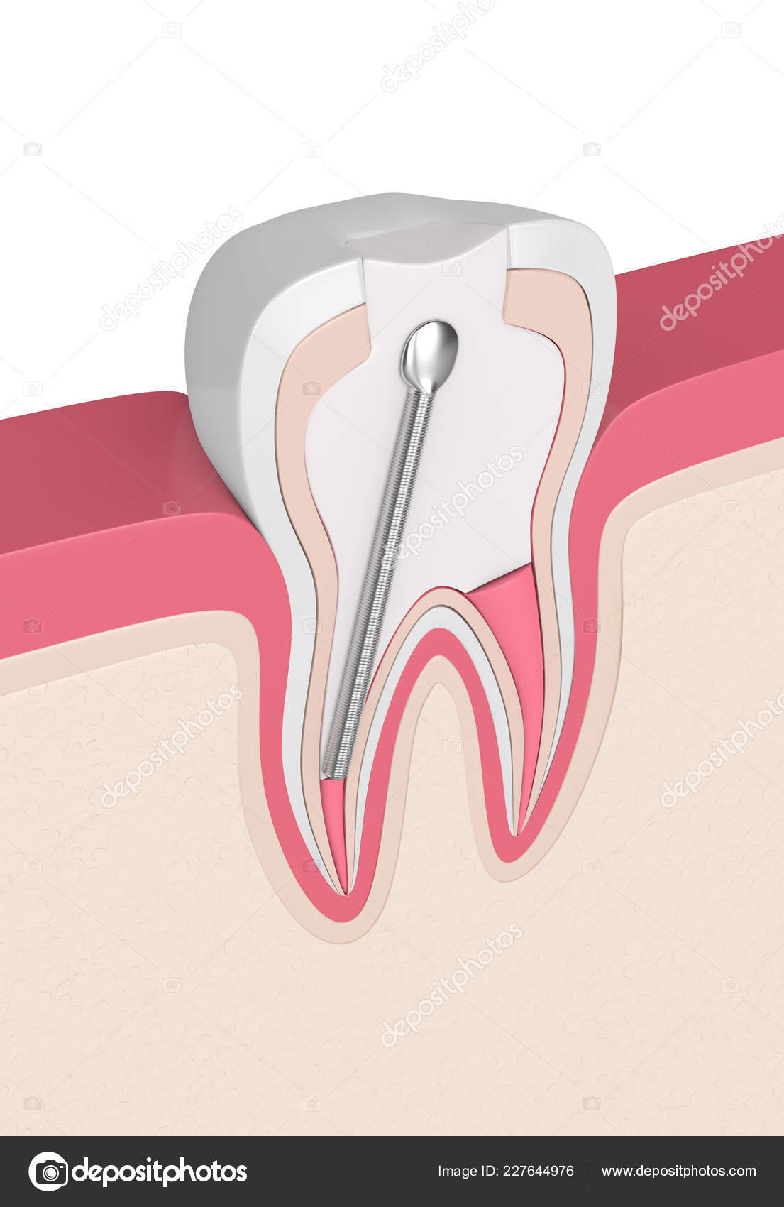 Render Tooth Stainless Steel Dental Post Filling Gums Endodontic