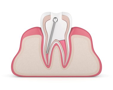 3D render diş diş etleri doldurarak paslanmaz çelik diş posta ile. Endodontik tedavi kavramı
