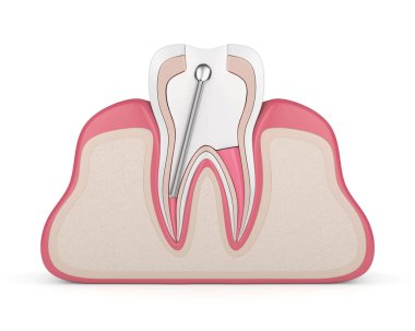 3d render of tooth with stainless steel dental post and filling in gums. Endodontic treatment concept clipart