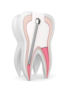 3D render Diş dolgu beyaz arka plan üzerinde paslanmaz çelik diş posta ile. Endodontik tedavi kavramı