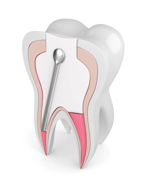 3D render Diş dolgu beyaz arka plan üzerinde paslanmaz çelik diş posta ile. Endodontik tedavi kavramı
