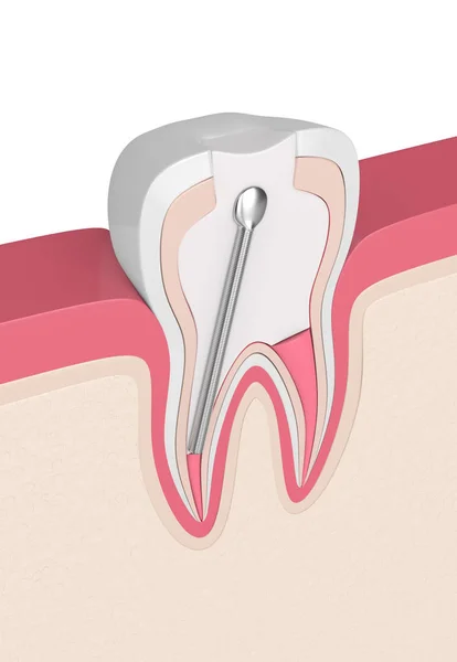 ステンレス鋼の歯科用ポストと歯茎で充填歯の のレンダリング 歯内治療コンセプト — ストック写真