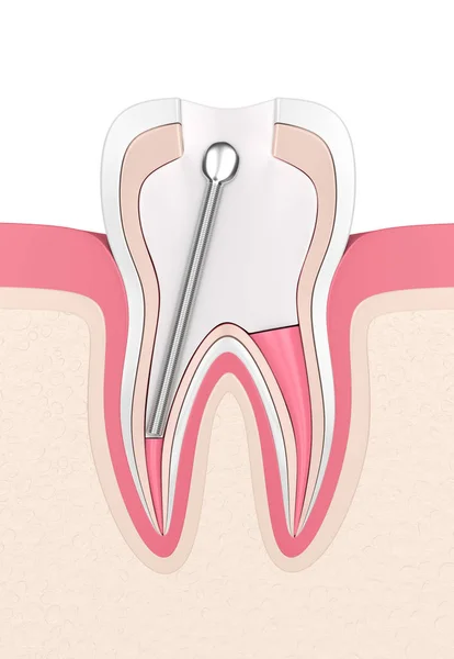ステンレス鋼の歯科用ポストと歯茎で充填歯の のレンダリング 歯内治療コンセプト — ストック写真