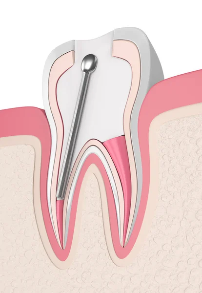 Renderização Dente Com Poste Dentário Aço Inoxidável Preenchimento Gengivas Conceito — Fotografia de Stock